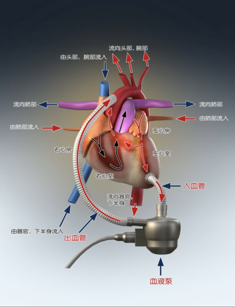 和大多数人理解的不同,人工心脏并不是一颗完整的人造的心脏,人工心脏